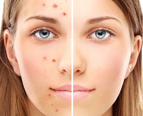 Acne and skin treatment before and after – best dermatologist in Jalandhar